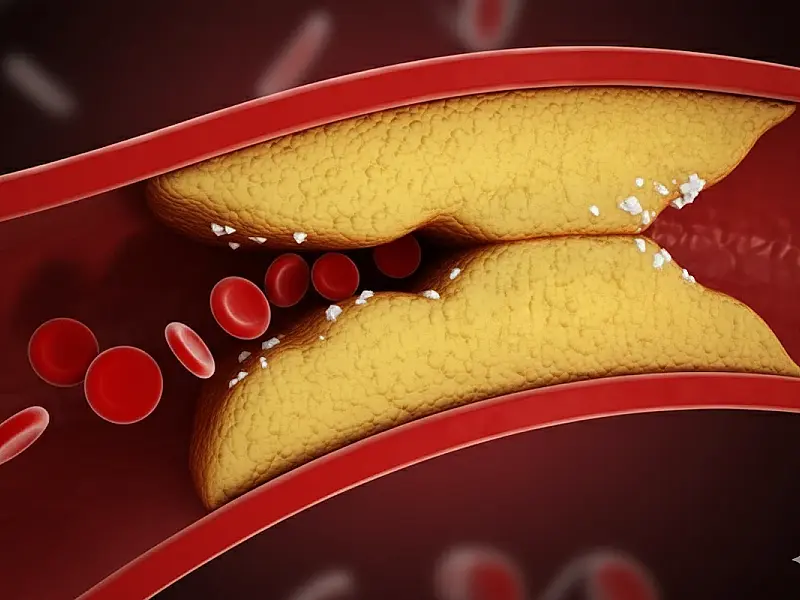 Como reduzir a gordura nas artérias: médico vascular revela estratégias comprovadas para proteger o coração