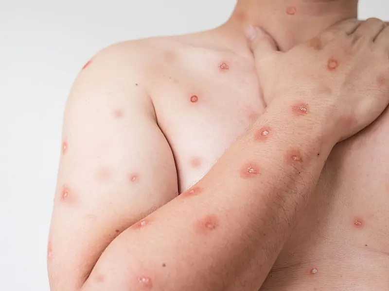 Casos de mpox no Brasil somam 88 confirmações em 2026, segundo o Ministério da Saúde.