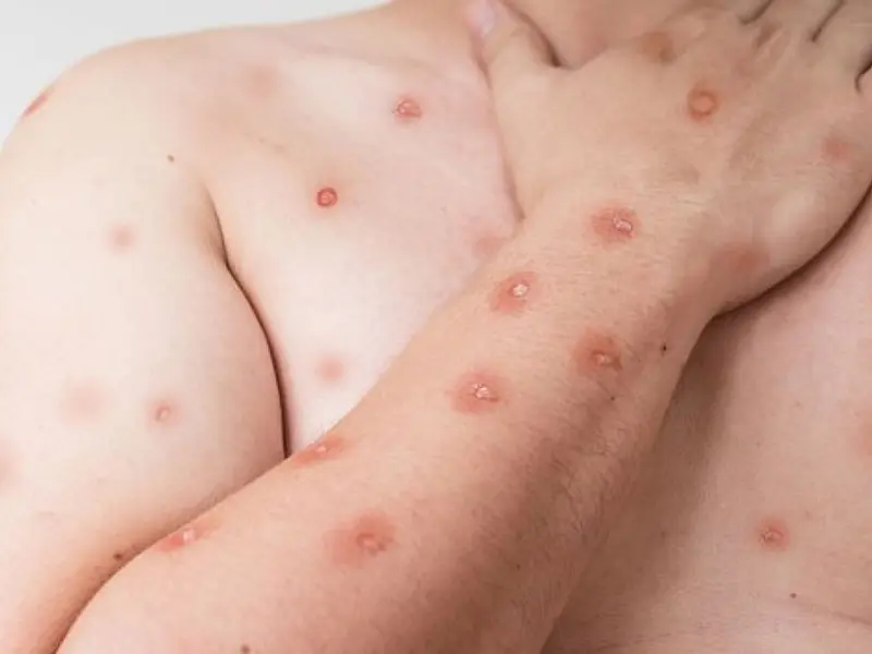 Ministério da Saúde reforça monitoramento e diagnóstico da mpox pelo SUS.