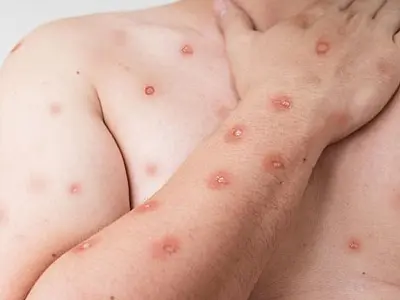 Ministério da Saúde reforça papel do SUS na detecção da mpox