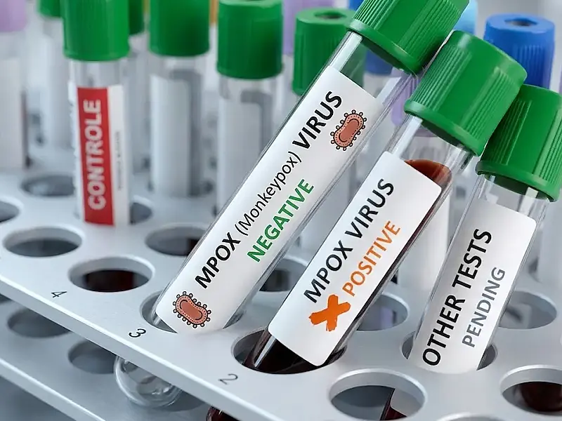Brasil registra 140 casos de Mpox em 2026, sem mortes, e intensifica vigilância em saúde