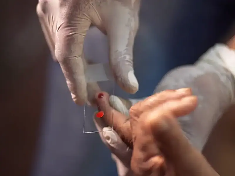 SUS começa a usar novo tratamento contra malária em crianças com dose única e foco na Amazônia Legal