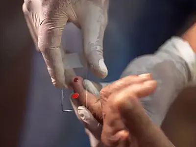 SUS inicia novo tratamento contra malária em crianças no Brasil