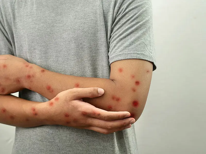 Lesões cutâneas características da Mpox em paciente