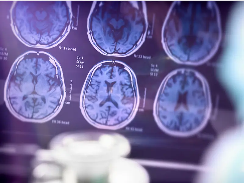 Nova tecnologia utiliza vesículas de células-tronco para atuar diretamente na redução da inflamação dos neurônios.