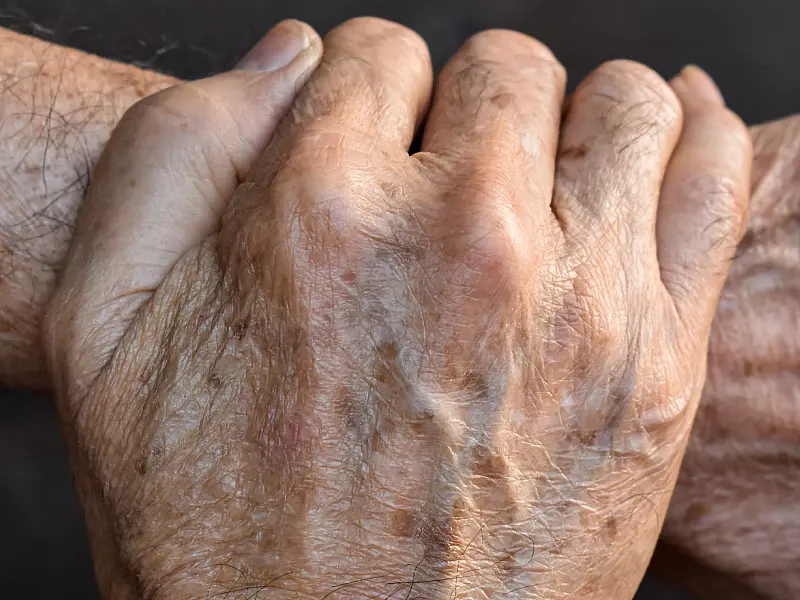 Especialistas recomendam avaliação médica periódica para analisar a evolução de marcas senis nas mãos e no corpo