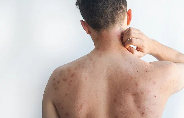 Torso masculino apresentando manchas e erupções avermelhadas provocadas por vírus