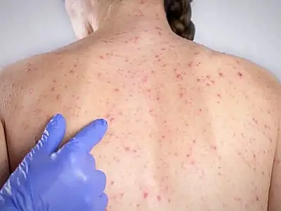 Alerta de saúde em SP: Casos de sarampo sobem e expõem falha na cobertura vacinal de bebês e adultos