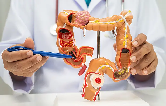 Profissional de saúde segurando um modelo anatômico de plástico do intestino humano